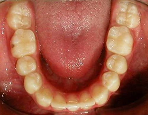 Fig. 26 Fotografía oclusal inferior final