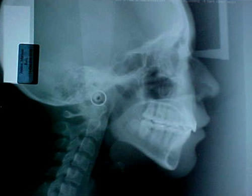 Fig. 27 Radiografía lateral de cráneo final