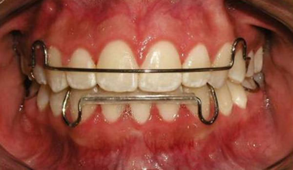 Fig. 29 Fotografía de frente con retenedores