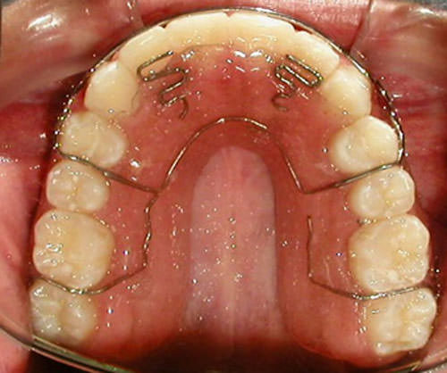 Fig. 30 Oclusal superior de retenedor