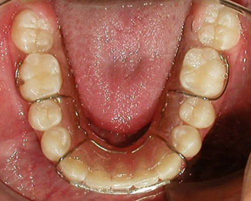 Fig. 3 Oclusal inferior de retenedor