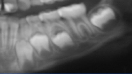 Ejemplo de cómo realizar la totalización de los valores y calcular la edad dental según las tablas de conversión