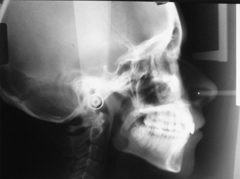 Foto 1 Radiografía cefálica labial