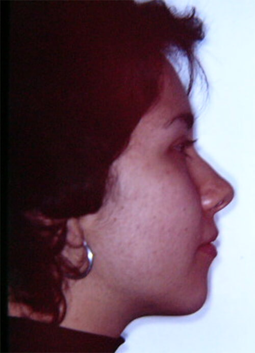 Foto 3 De Perfil Se puede observar su convexidad facial