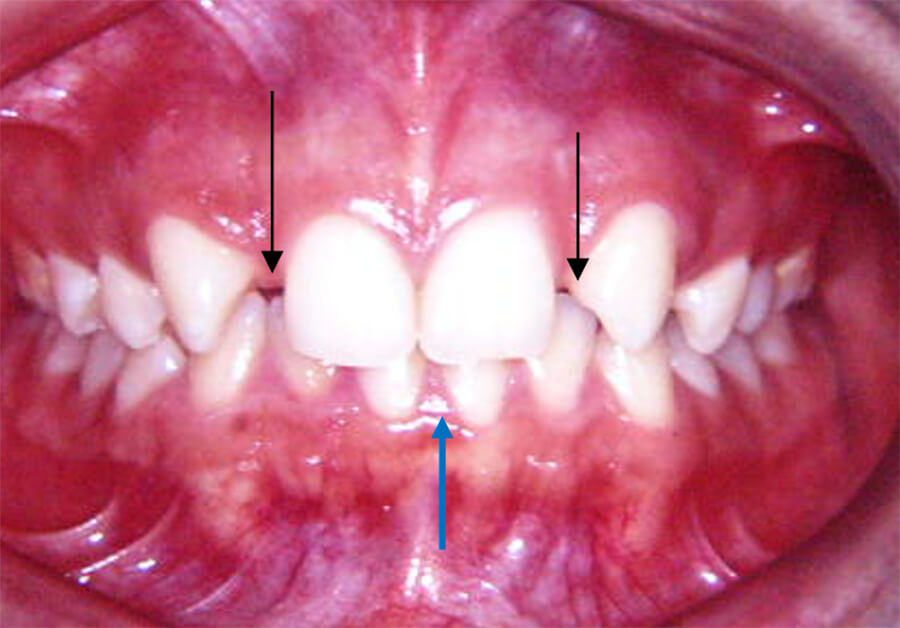 Foto 5 Sonrisa, observamos, ausencia de incisivos laterales superiores, coincidencia de línea media facial con línea media dental superior y desviación de 1mm hacia la izquierda de la línea media dental inferior con respecto a la dental superior