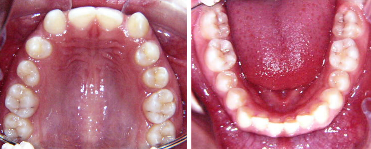 Foto 6 Oclusal Superior e Inferior, se puede observar: forma cuadrada del arco maxilar y oval del arco mandibular, agenesia de incisivos laterales maxilares, espacios interdentarios maxilares, y ligero apiñamiento mandibular.