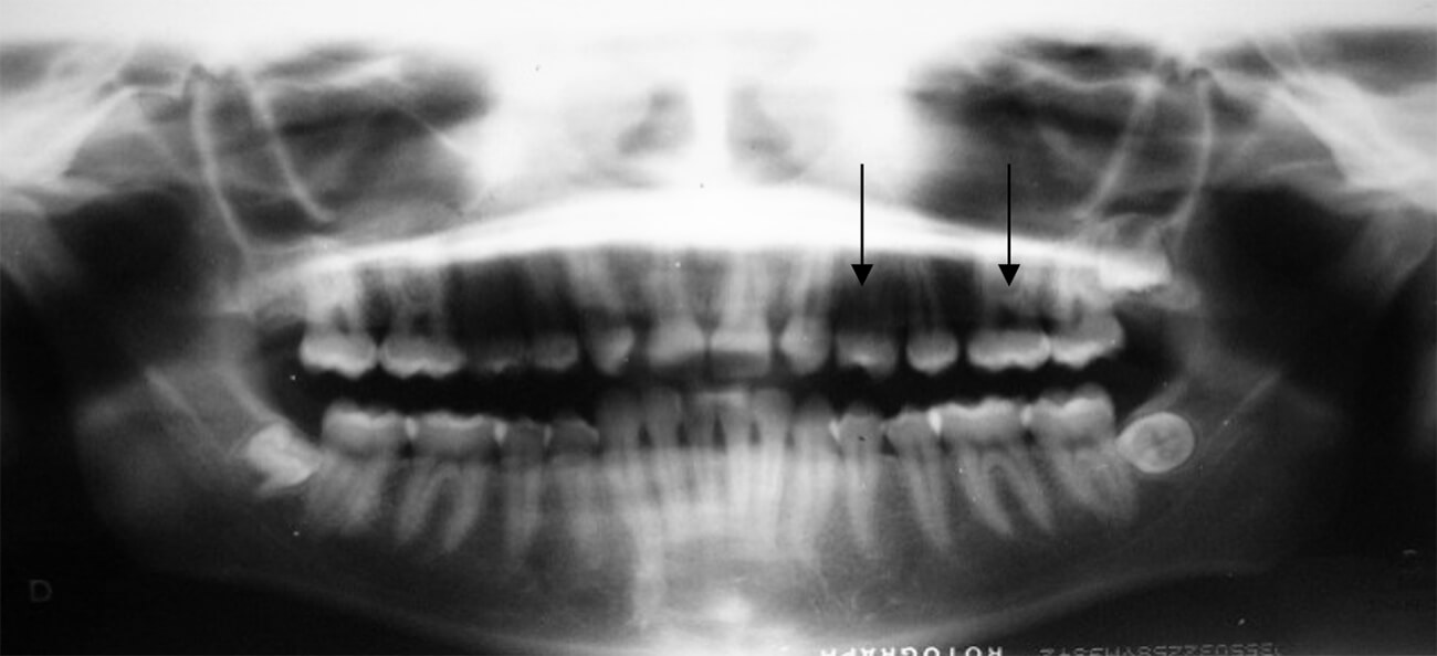 Foto 7 Radiografía panorámica, se corrobora la ausencia de incisivos laterales maxilares