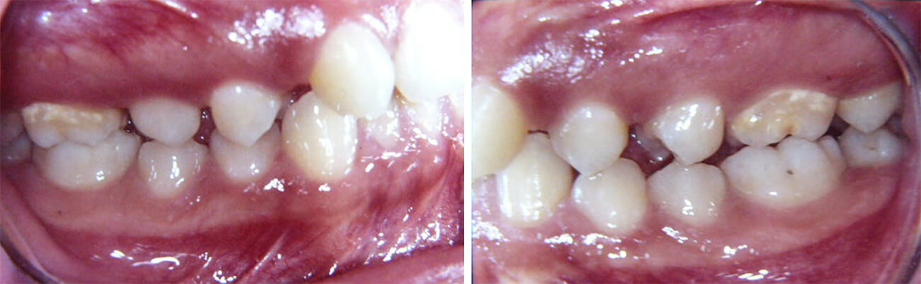 Foto 8 Intraoral lateral derecha e izquierda, muestra: Agenesia de incisivos laterales maxilares, Clase II molar bilateral, Clase II canina bilateral.