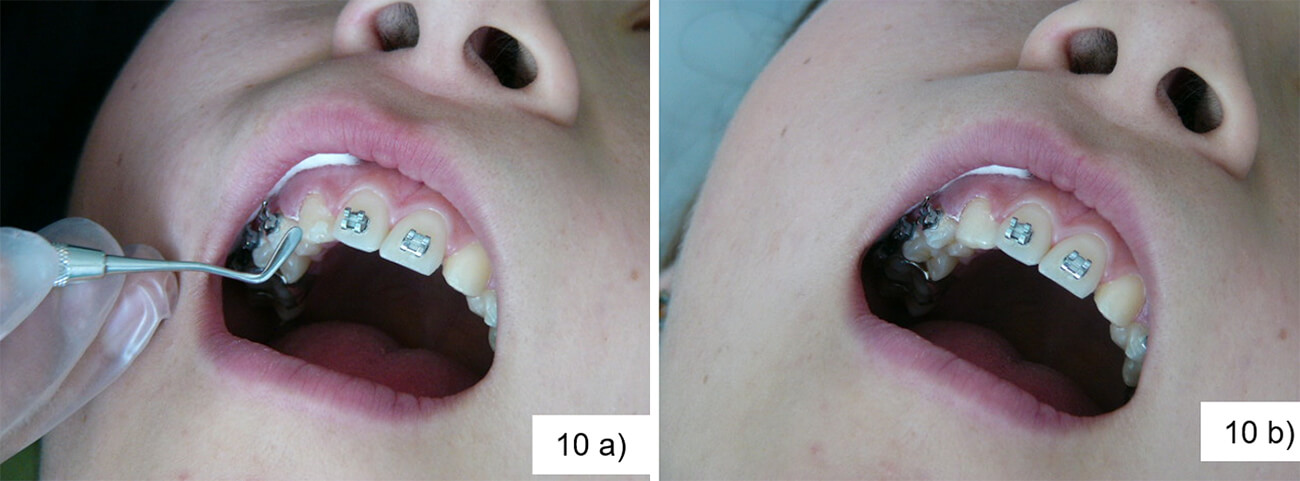 Foto 10 a) Fase restauradora, terminación de la aplicación de la resina, se puede observar. Foto 10 b) La eliminación de excesos, contorno y detallado a las estructuras dentarias, logrando la anatomía deseada