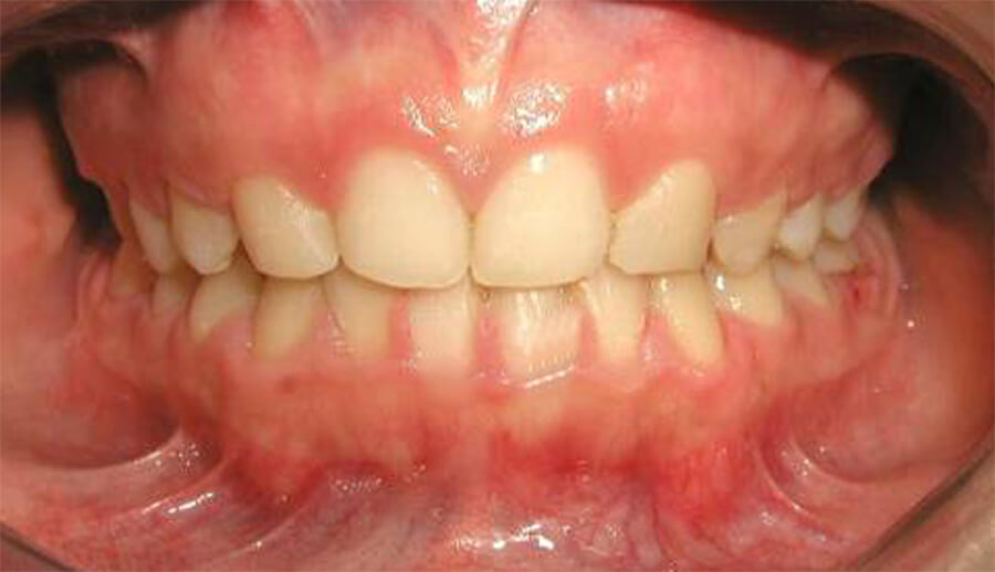 Foto 14 Sonrisa Intraoral- se puede observar la casi coincidencia de línea media dental superior con dental inferior.
