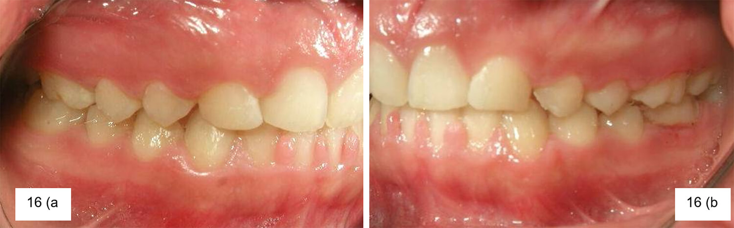 Foto 16 a y 16 b Intraoral lateral derecha e izquierda Se observa: agenesia de incisivos laterales maxilares, transformación estética de caninos maxilares en incisivos laterales maxilares, Clase II molar funcional bilateral, Clase I canina bilateral