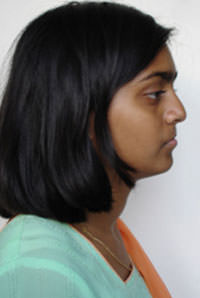 Fig.2 Pre treatment extra oral profile