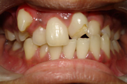 Fig.4 Pre-treatment Intra-oral frontal view