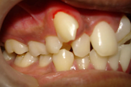 Fig.5 Pre-treatment Intra-oral right side view
