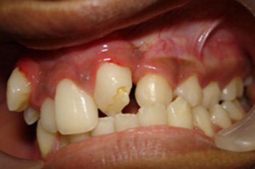 Fig.6 Pre-treatment Intra-oral left side view