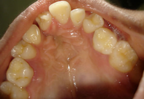 Fig.7 Pretreatment Maxillary arch occlusal view