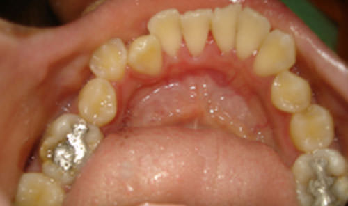 Fig.8 Pre treatment Mandibular arch occlusal view