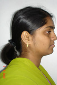 Fig.10 Post treatment extra oral profile