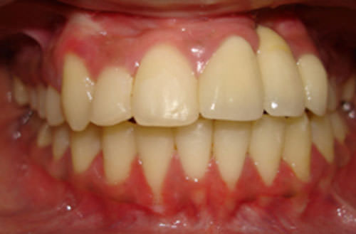 Fig.12 Post-treatment Intra-oral frontal view