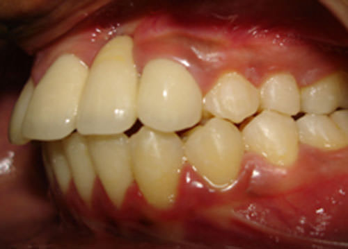 Fig.13 Post-treatment Intra-oral right side view