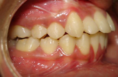 Fig.14 Post-treatment Intra-oral left side view