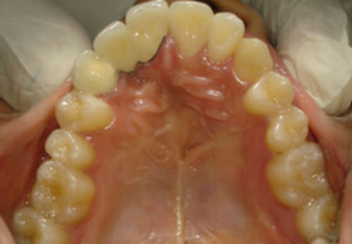 Fig.15 Post treatment Maxillary arch occlusal view