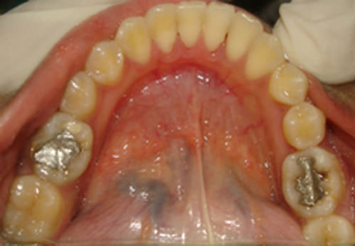 Fig.16 Post treatment Mandibular arch occlusal view