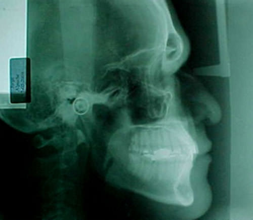 Fig.4 Rx. lateral de cráneo inicial