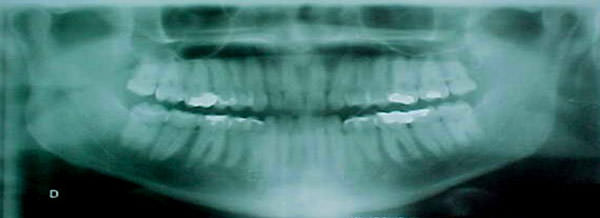 Fig.5 Rx panorámica inicial se observan los 31 dientes presentes.