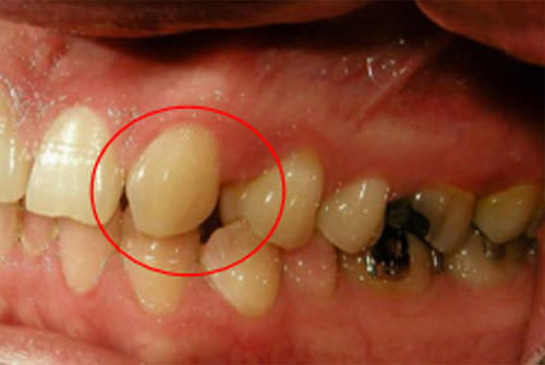 Fig. 7 Lateral izquierda inicial