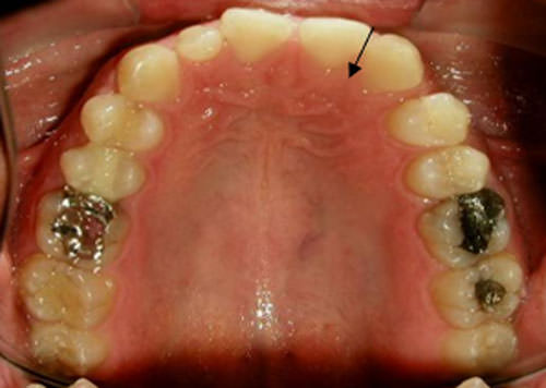 Fig. 8 Fotografía oclusal superior