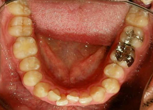 Fig. 9 Fotografía oclusal inferior inicio