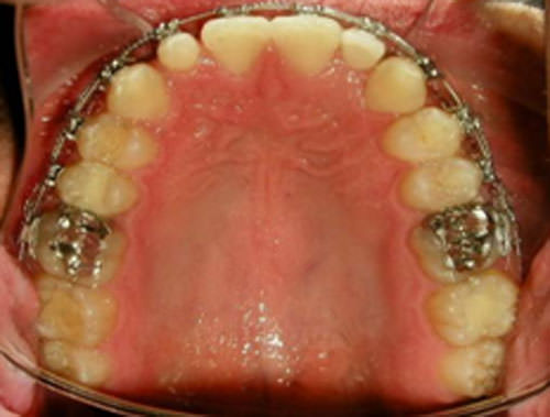 Fig. 12 Oclusal superior progreso