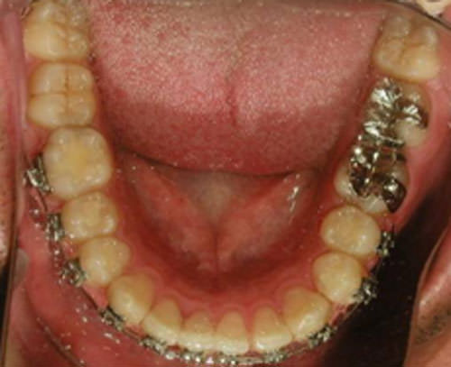 Fig. 13 Oclusal inferior progreso