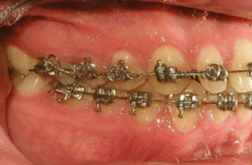 Fig. 15 Fotografía lateral derecha progreso
