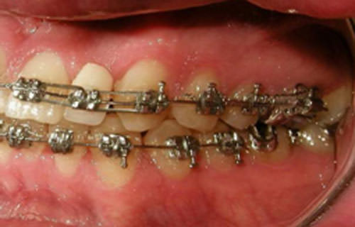 Fig. 16 Lateral izquierda progreso
