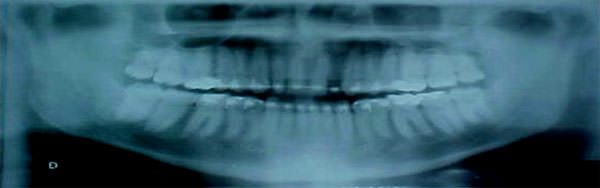 Fig. 18 Radiografía panorámica de progreso.