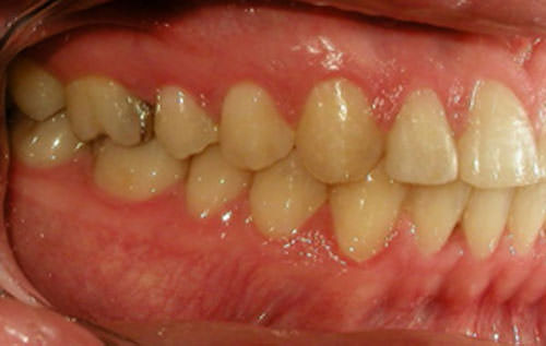 Fig. 23 Lateral derecha final