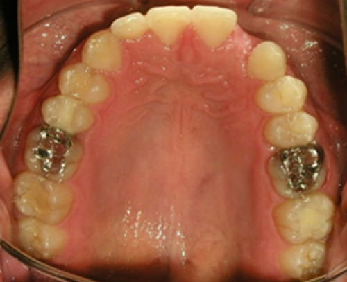 Fig. 25 Fotografía oclusal superior final