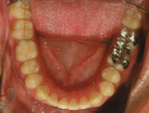 Fig. 26 Oclusal inferior final