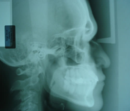 Fig. 27 Radiografía lateral de cráneo final