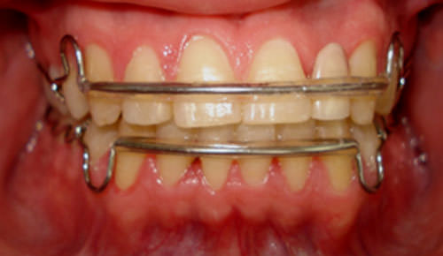 Fig. 29 Fotografía de frente con retenedores circunferencial superior e inferior, con cinturones vestibulares