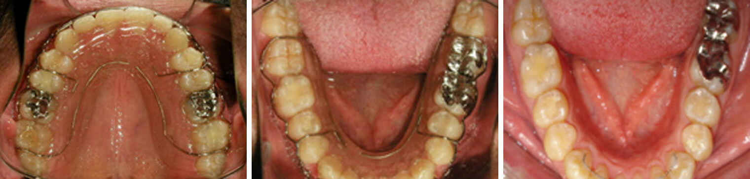 Fig. 30 Vista oclusal de los retenedor res, circunferencial superior e inferior y retenedor fijo de 3 a 3 inf