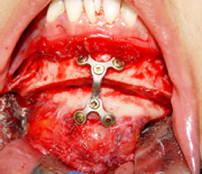 Fig. 3 Fijación interna