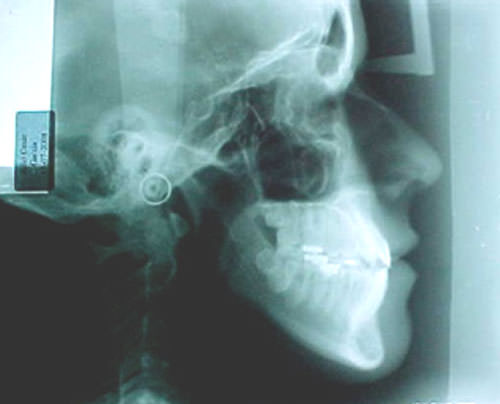 Figura 1 Radiografía lateral de cráneo. Fuente propia CESO