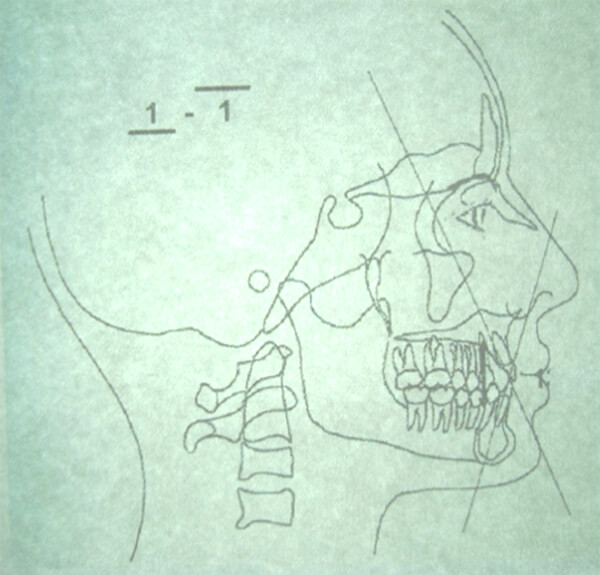 Figura 4 Radiografía de inicio de paciente del Centro De Estudios Superiores de Ortodoncia. máster de la radiografía y un trazo cefalometrico. Fuente propia CESO