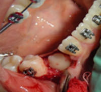 Figura 14