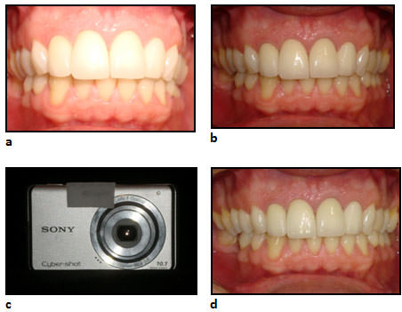 Figure 2 Overexposed photograph (a), represented by excess lighting. Mainly the right buccal corridor was dark (b), without uniform distribution of light due to flash positioning on the right side of the camera (c). Correct lighting (d). 