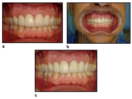 Figure 4 Use of point flash with insufficient illumination of the object, due to the proximity of the camera (a). Focusing from a more distant position allows better illumination and greater area of capture, thus requiring higher resolution (b). In (c) trimming of the area of interest exhibiting good lighting. 