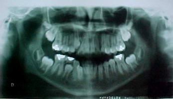 Radiografía panorámica de inicio (fig.4)